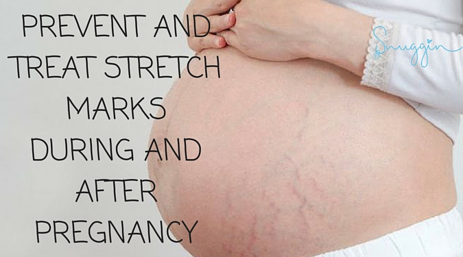 Mommy How-To: Prevent and Treat Stretch Marks During and After